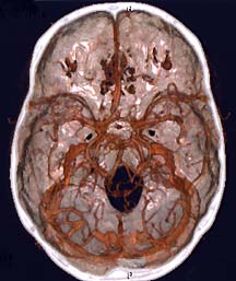 Brain Angiogram