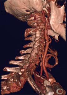 Carotid Angiogram