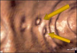 Diverticulum