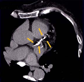 High Risk Coronary Artery