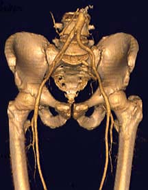 Lower Extremity Angiogram