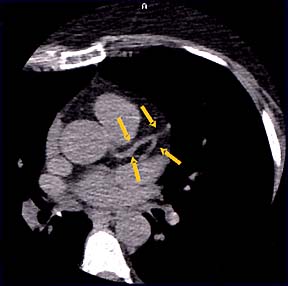 Low Risk Coronary Arter