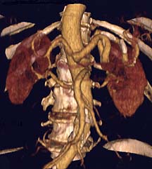 Renal Angiogram